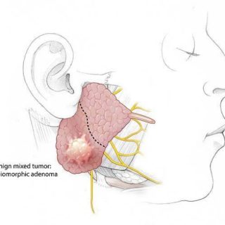 Pleomorphic adenoma parotid in Bangalore